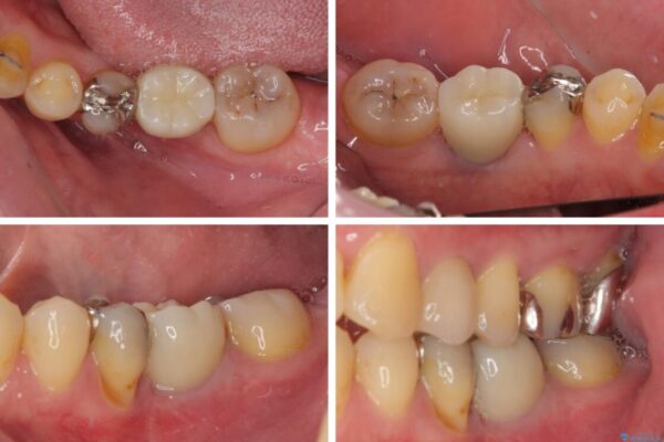 割れてしまった奥歯とデコボコの前歯　矯正治療とインプラント治療 治療後画像