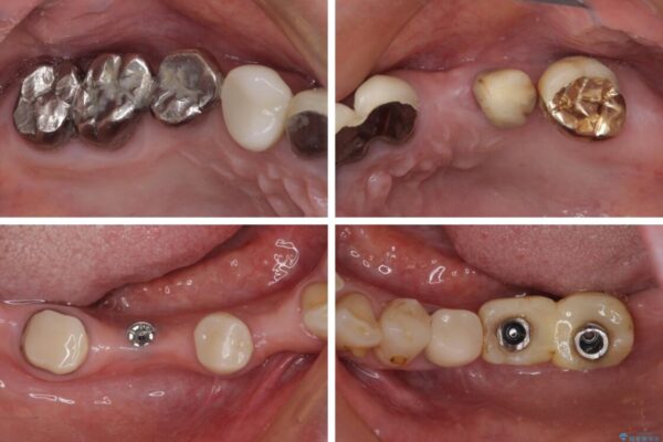放置したインプラントとインビザライン　全顎リカバリー治療 治療前画像