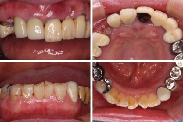 前歯をきれいにしたい　インプラントや部分矯正を用いた総合歯科治療 治療前画像