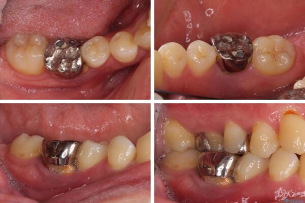 割れてしまった奥歯とデコボコの前歯　矯正治療とインプラント治療 治療前画像