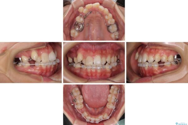 気になる八重歯　目立ちにくいハーフリンガルでの抜歯矯正 治療途中画像