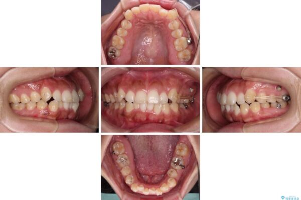 【モニター】カリエール・ディスタライザーを併用した八重歯のインビザライン矯正 治療途中画像