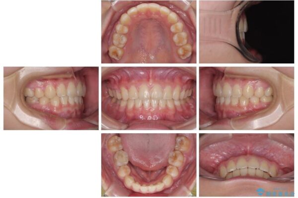 転勤でも安心して治療継続　抜歯スペース閉鎖と深い噛み合わせ改善のワイヤー矯正 治療後画像