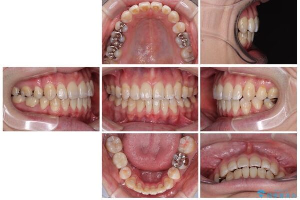 口元の突出感を改善!目立ちにくいワイヤー矯正で自信を持てる自然な横顔に 治療後画像
