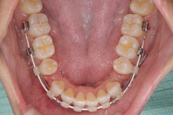 抜歯矯正で唇を閉じやすく　目立たないワイヤー装置 治療途中画像