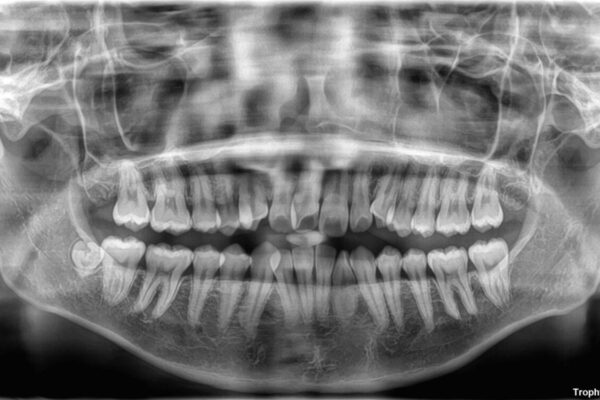 【モニター】前歯のデコボコをスッキリ解消!目立ちにくいワイヤー矯正でスピーディに治療完了 治療前画像