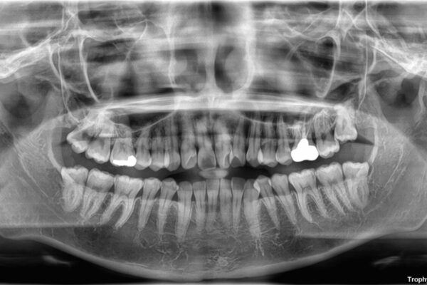 前歯のねじれ・ガタガタを10か月で改善!20代女性の矯正治療|クリアブラケットでむし歯になりにくい歯並びへ改善 治療前画像