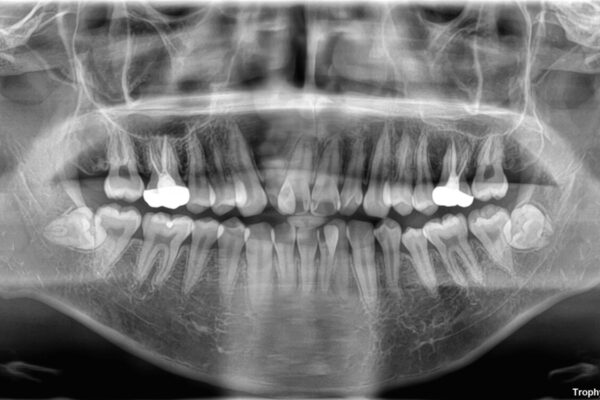 1年でここまで変わる!歯列のがたつきと正中のズレを改善した矯正治療(メタルブラケット×MARPE) 治療前画像