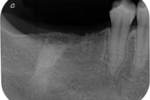 挺出歯を圧下してスペースを確保!目立たない部分矯正で下顎大臼歯にインプラント治療を実現 治療前画像