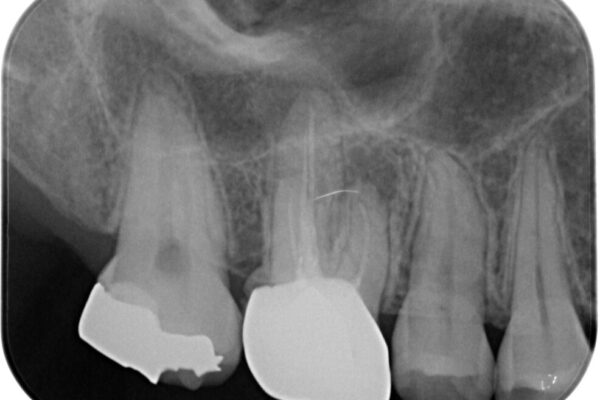 挺出歯を圧下してスペースを確保!目立たない部分矯正で下顎大臼歯にインプラント治療を実現 治療前画像