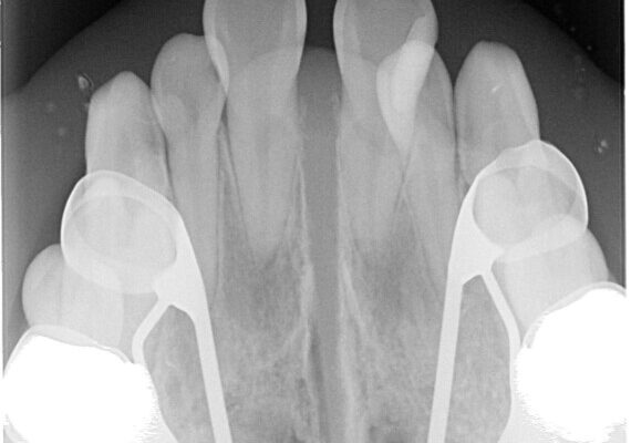 1年でここまで変わる!歯列のがたつきと正中のズレを改善した矯正治療(メタルブラケット×MARPE) 治療途中画像