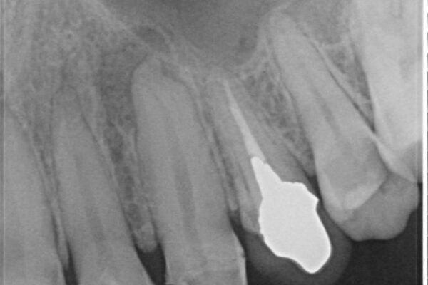 「抜歯してブリッジ」と言われた20代女性が選んだ治療とは|たった4か月で自然な笑顔に抜歯即時インプラント+審美補綴の症例 治療前画像