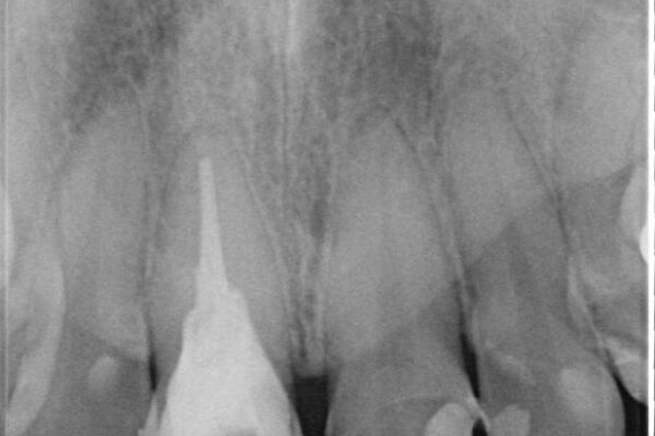 「抜歯してブリッジ」と言われた20代女性が選んだ治療とは|たった4か月で自然な笑顔に抜歯即時インプラント+審美補綴の症例 治療前画像