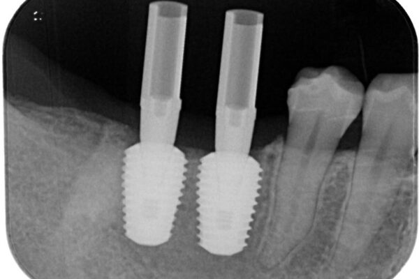 挺出歯を圧下してスペースを確保!目立たない部分矯正で下顎大臼歯にインプラント治療を実現 治療途中画像