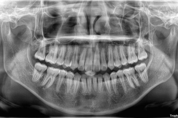 【モニター】前歯のデコボコをスッキリ解消!目立ちにくいワイヤー矯正でスピーディに治療完了 治療後画像