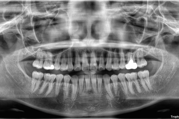 前歯のねじれ・ガタガタを10か月で改善!20代女性の矯正治療|クリアブラケットでむし歯になりにくい歯並びへ改善 治療後画像