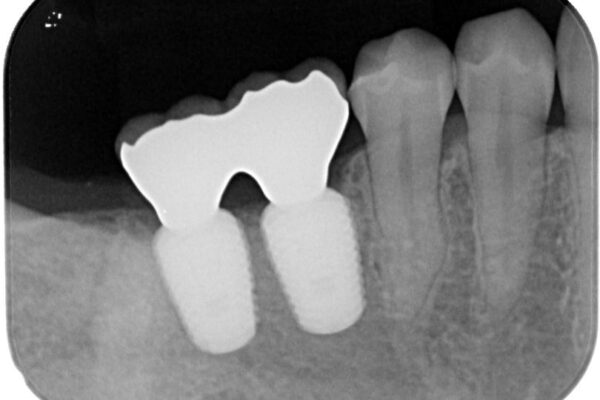 挺出歯を圧下してスペースを確保!目立たない部分矯正で下顎大臼歯にインプラント治療を実現 治療後画像