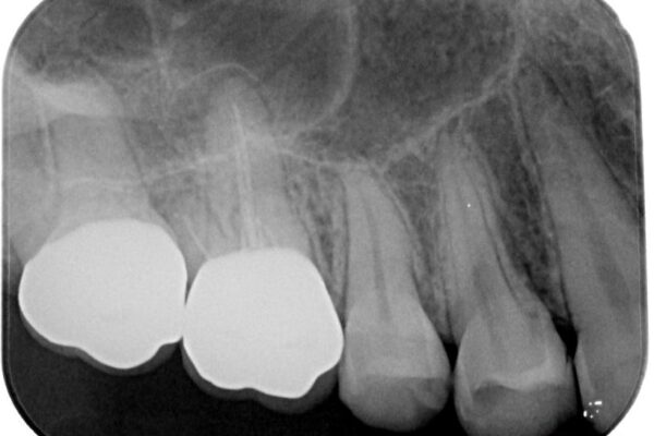 挺出歯を圧下してスペースを確保!目立たない部分矯正で下顎大臼歯にインプラント治療を実現 治療後画像