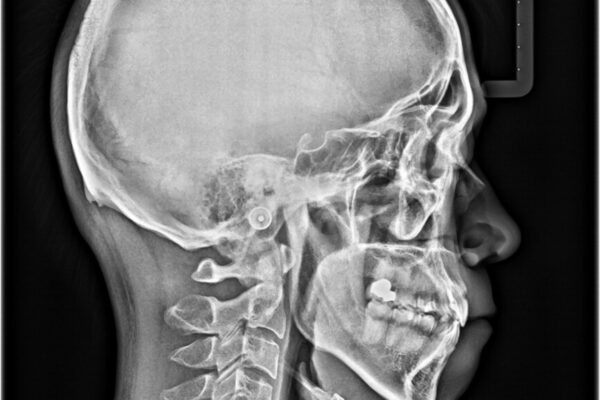 八重歯と前歯のガタガタを抜歯矯正で治療|クリアブラケット使用例 治療後画像