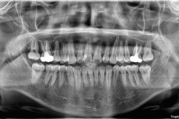 1年でここまで変わる!歯列のがたつきと正中のズレを改善した矯正治療(メタルブラケット×MARPE) 治療後画像