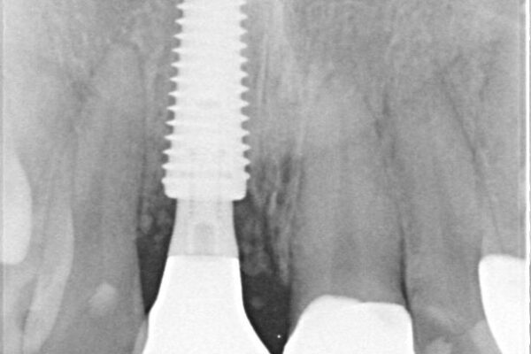 「抜歯してブリッジ」と言われた20代女性が選んだ治療とは|たった4か月で自然な笑顔に抜歯即時インプラント+審美補綴の症例 治療後画像