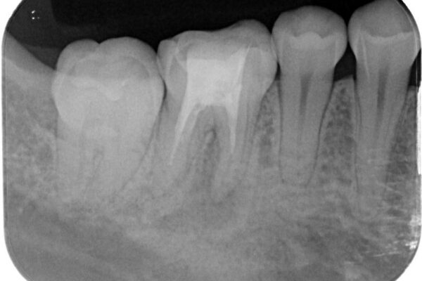 ラバーダム使用で再感染リスクを抑えた再根管治療+精密な補綴による長期安定を実現 治療前画像