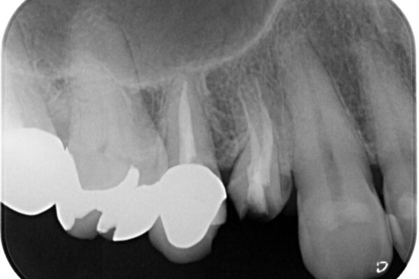 自然な美しさと強度を両立!右上小臼歯の被せもの脱離に対する審美補綴治療 治療前画像