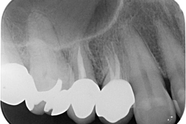 自然な美しさと強度を両立!右上小臼歯の被せもの脱離に対する審美補綴治療 治療後画像
