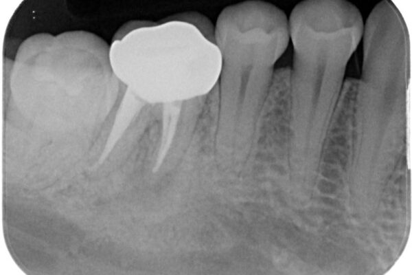 ラバーダム使用で再感染リスクを抑えた再根管治療+精密な補綴による長期安定を実現 治療後画像