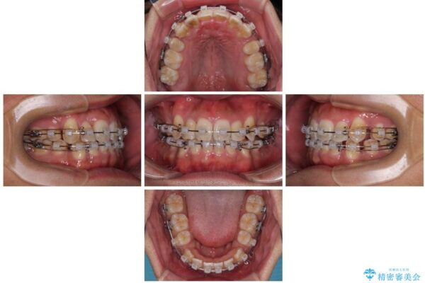 八重歯と前歯のガタガタを抜歯矯正で治療|クリアブラケット使用例 治療途中画像