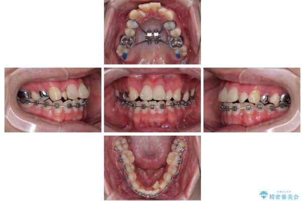 1年でここまで変わる!歯列のがたつきと正中のズレを改善した矯正治療(メタルブラケット×MARPE) 治療途中画像