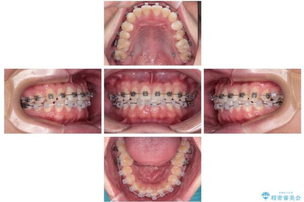 前歯のガタガタ・奥歯のかみ合わせ(シザーズバイト)を改善|1年半で完了したメタルブラケット矯正 治療途中画像