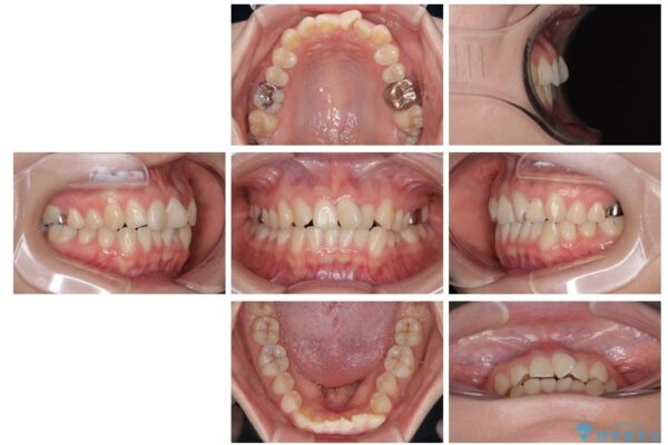 前歯のねじれ・ガタガタを10か月で改善!20代女性の矯正治療|クリアブラケットでむし歯になりにくい歯並びへ改善 治療前画像