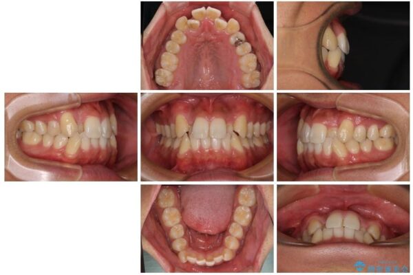 八重歯と前歯のガタガタを抜歯矯正で治療|クリアブラケット使用例 治療前画像