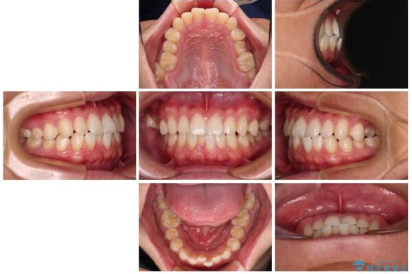 前歯のガタガタ・奥歯のかみ合わせ(シザーズバイト)を改善|1年半で完了したメタルブラケット矯正 治療前画像