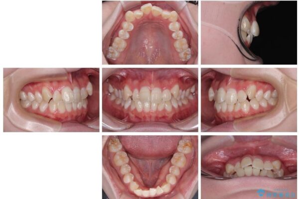 【モニター】前歯のデコボコをスッキリ解消!目立ちにくいワイヤー矯正でスピーディに治療完了 治療前画像