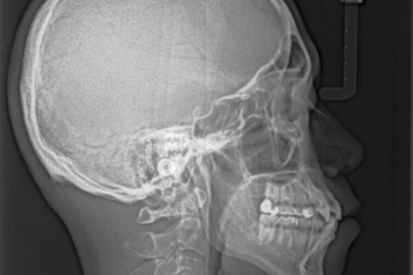 八重歯と前歯のガタガタを抜歯矯正で治療|クリアブラケット使用例 治療前画像
