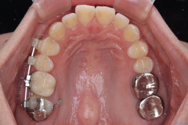 挺出歯を圧下してスペースを確保!目立たない部分矯正で下顎大臼歯にインプラント治療を実現 治療途中画像