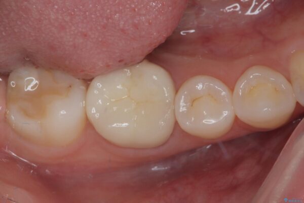 ラバーダム使用で再感染リスクを抑えた再根管治療+精密な補綴による長期安定を実現 アフター