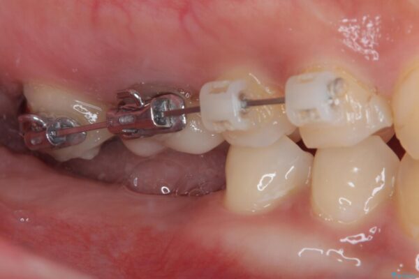 挺出歯を圧下してスペースを確保!目立たない部分矯正で下顎大臼歯にインプラント治療を実現 治療途中画像
