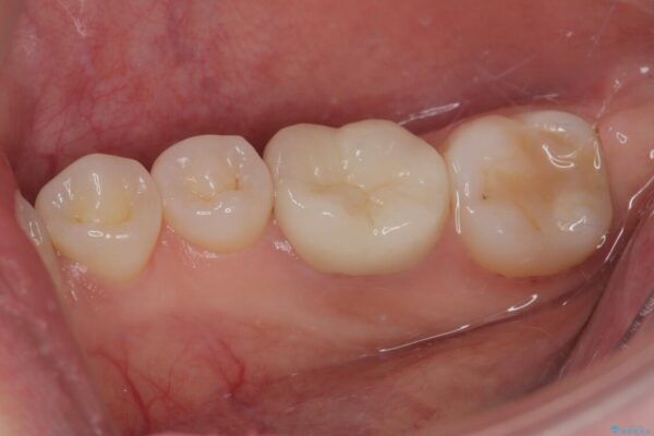 ラバーダム使用で再感染リスクを抑えた再根管治療+精密な補綴による長期安定を実現 治療後画像