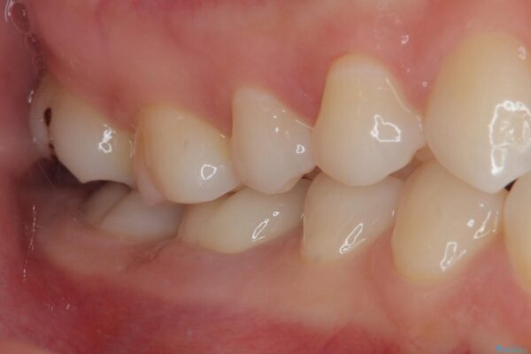 ラバーダム使用で再感染リスクを抑えた再根管治療+精密な補綴による長期安定を実現 治療後画像