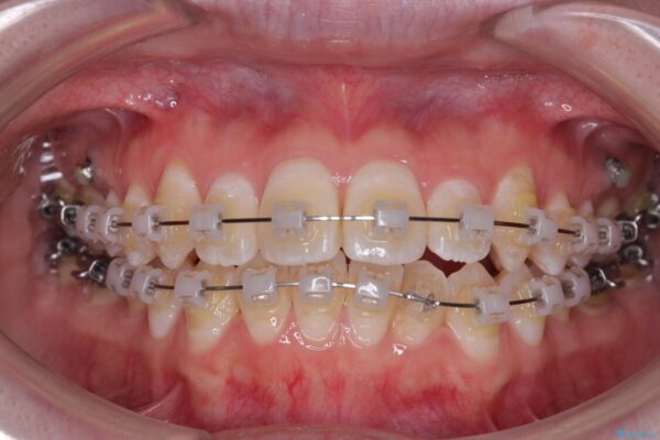【モニター】前歯のデコボコをスッキリ解消!目立ちにくいワイヤー矯正でスピーディに治療完了 治療途中画像