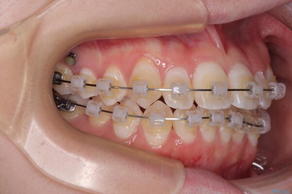【モニター】前歯のデコボコをスッキリ解消!目立ちにくいワイヤー矯正でスピーディに治療完了 治療途中画像