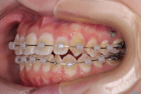 【モニター】前歯のデコボコをスッキリ解消!目立ちにくいワイヤー矯正でスピーディに治療完了 治療途中画像