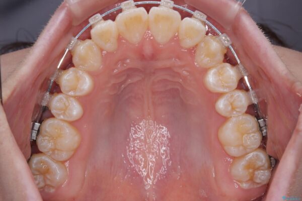 【モニター】前歯のデコボコをスッキリ解消!目立ちにくいワイヤー矯正でスピーディに治療完了 治療途中画像