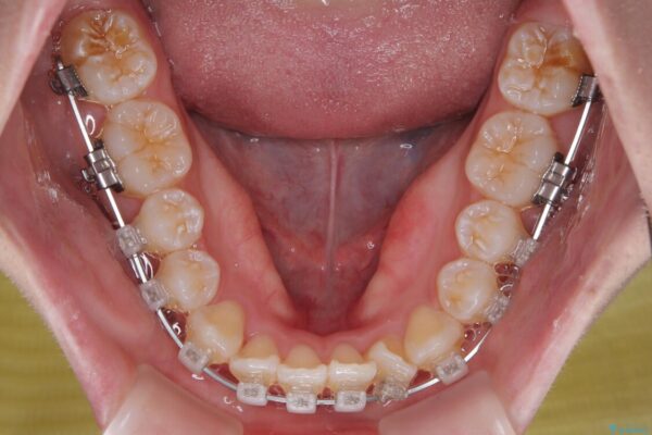 【モニター】前歯のデコボコをスッキリ解消!目立ちにくいワイヤー矯正でスピーディに治療完了 治療途中画像