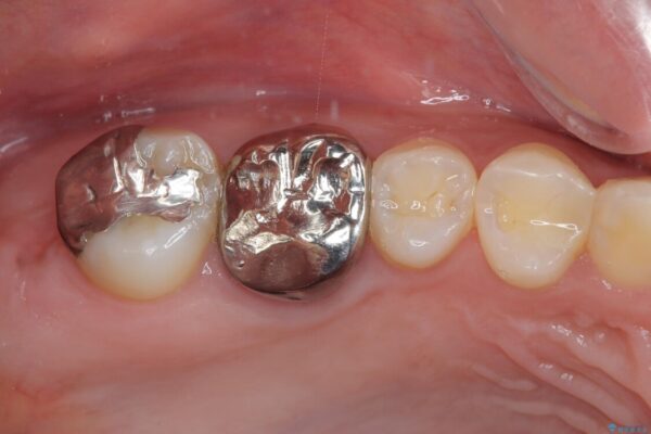 挺出歯を圧下してスペースを確保!目立たない部分矯正で下顎大臼歯にインプラント治療を実現 治療前画像