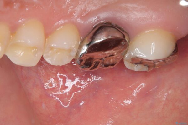 挺出歯を圧下してスペースを確保!目立たない部分矯正で下顎大臼歯にインプラント治療を実現 治療前画像