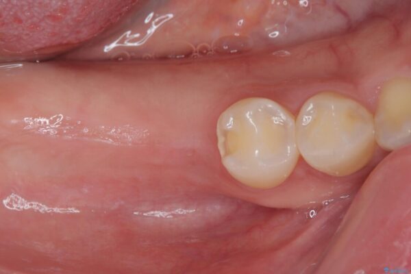 挺出歯を圧下してスペースを確保!目立たない部分矯正で下顎大臼歯にインプラント治療を実現 治療前画像